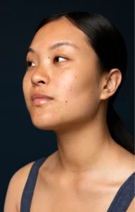 hyperpigmentation treatment by DrY