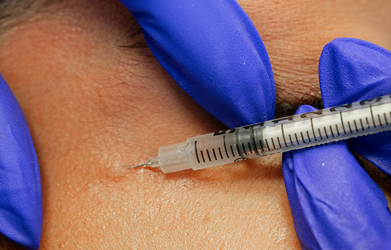 Profhilo in London is best