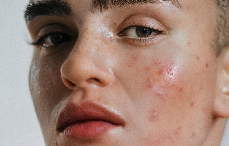 Who Benefits from London Acne Treatment?