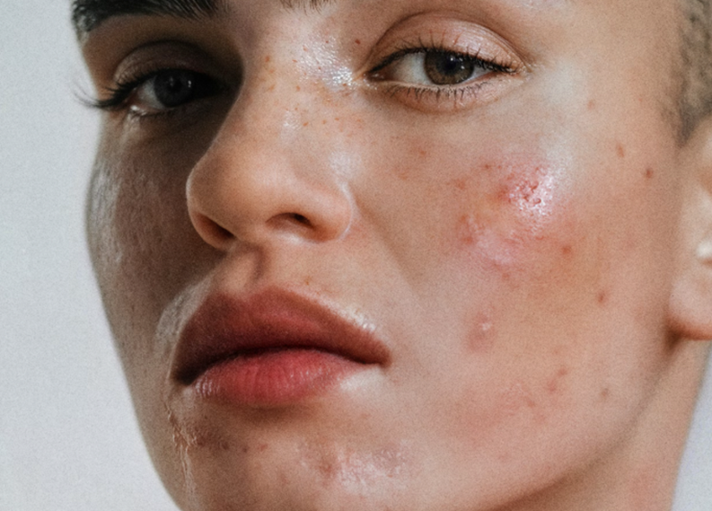 Anti-Wrinkle Injection Downtime