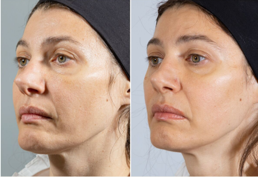 Before and after Skinvive treatment showing smoother, hydrated and radiant skin without added volume