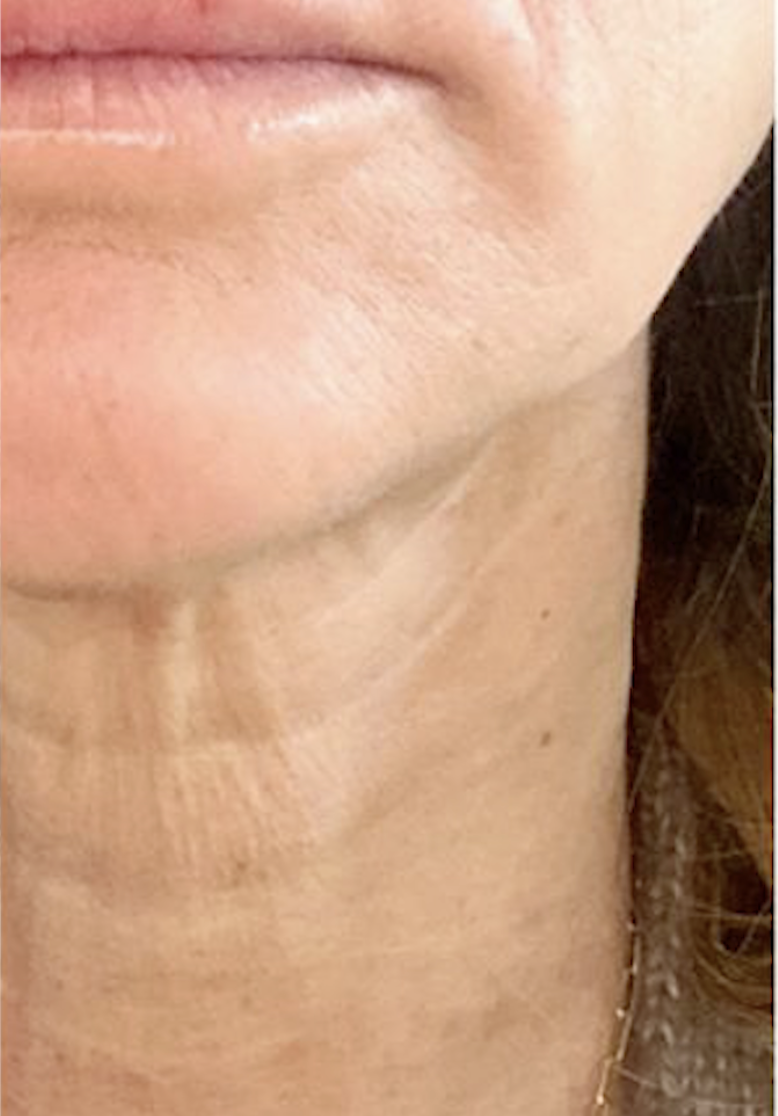After treatment