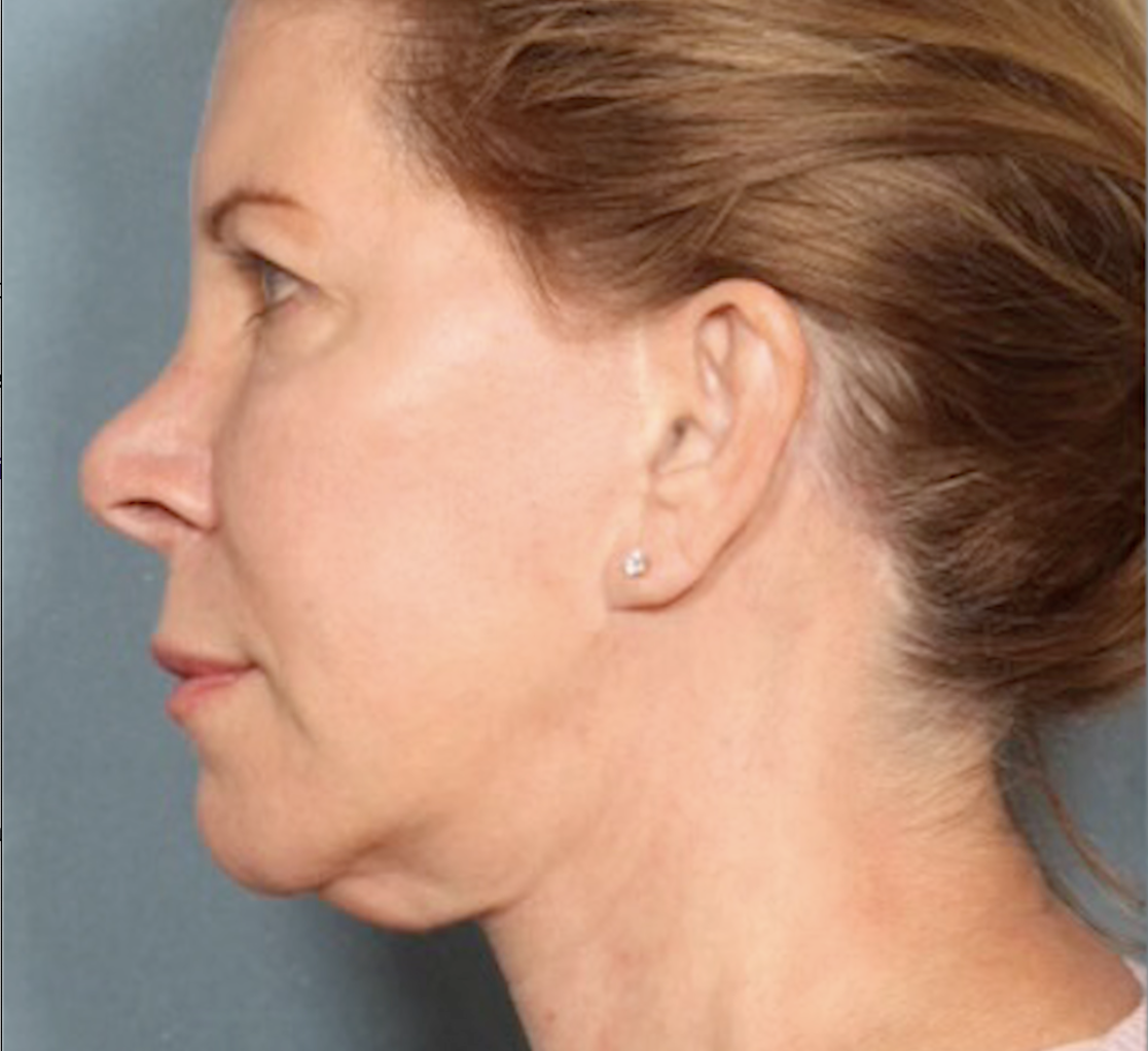 Before treatment